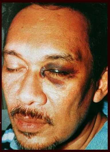 black eye